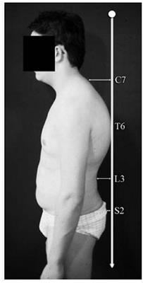 Prevalence of and Risk Factors for Sagittal Posture Abnormalities in Children Born With Esophageal Atresia: A Prospective Cohort Study